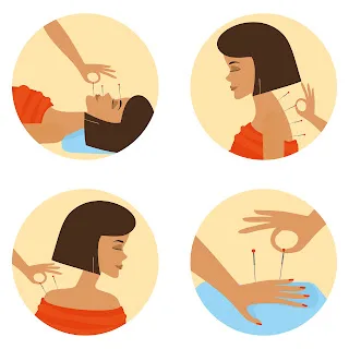 Acupuncture for anxiety and depression