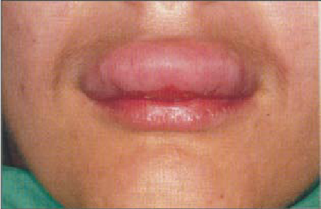 Hereditary angioedema symptoms