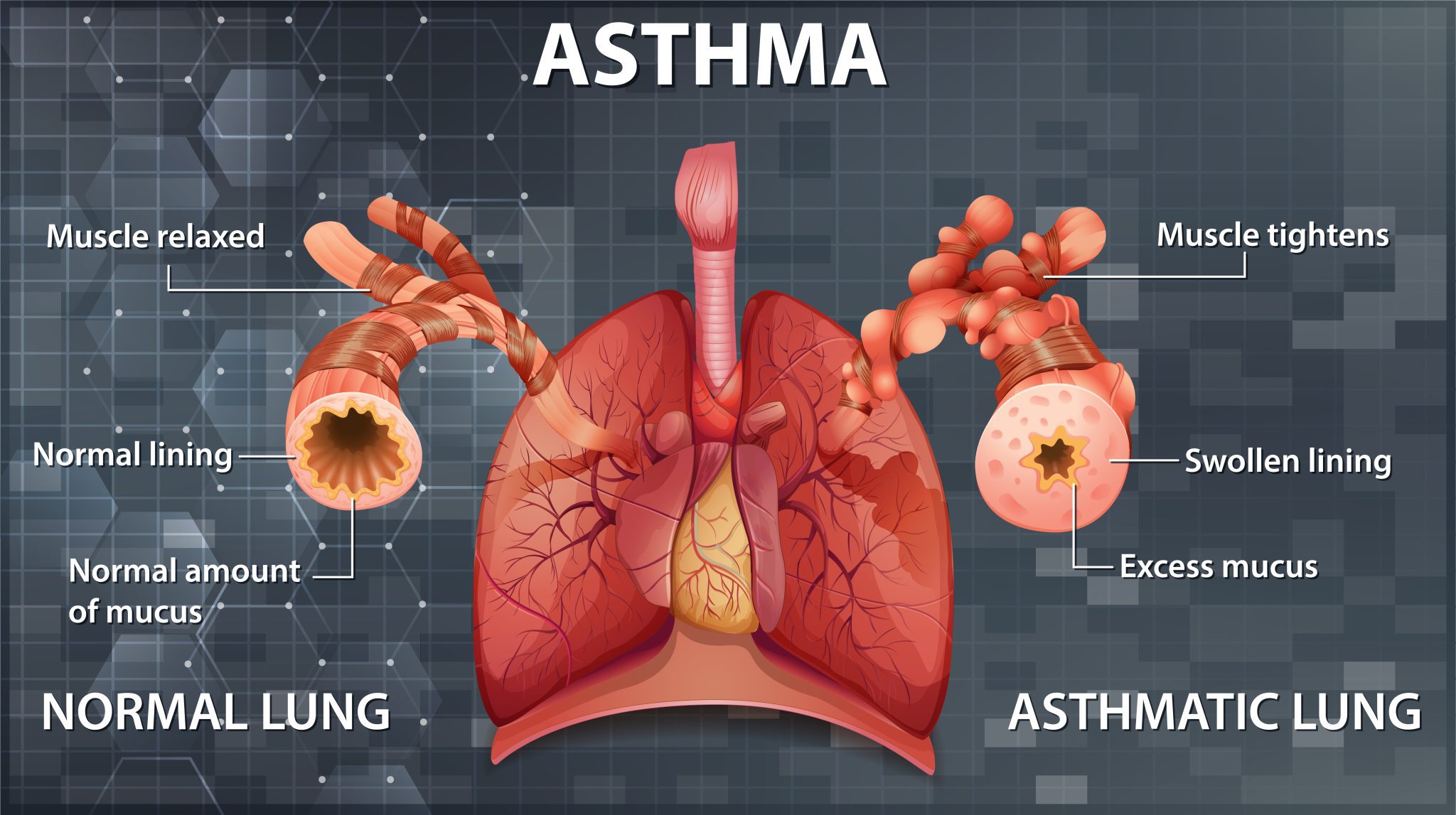 "Breath Relief A Guide to Managing Asthma Effectively" Fit Life Insights