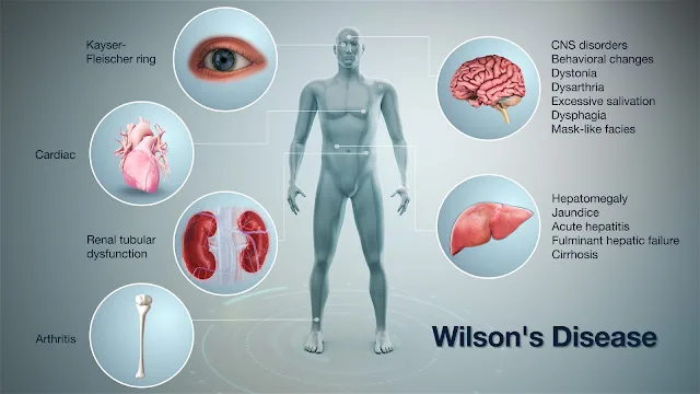 Wilsons disease causes and symptoms