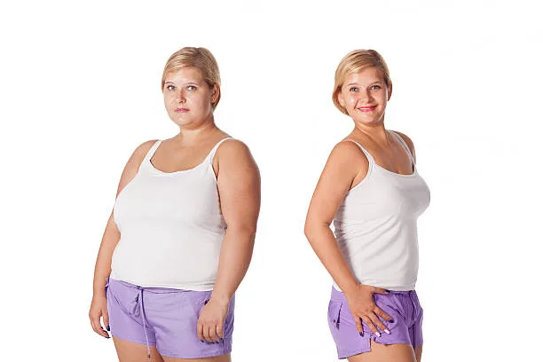 Weight loss surgery