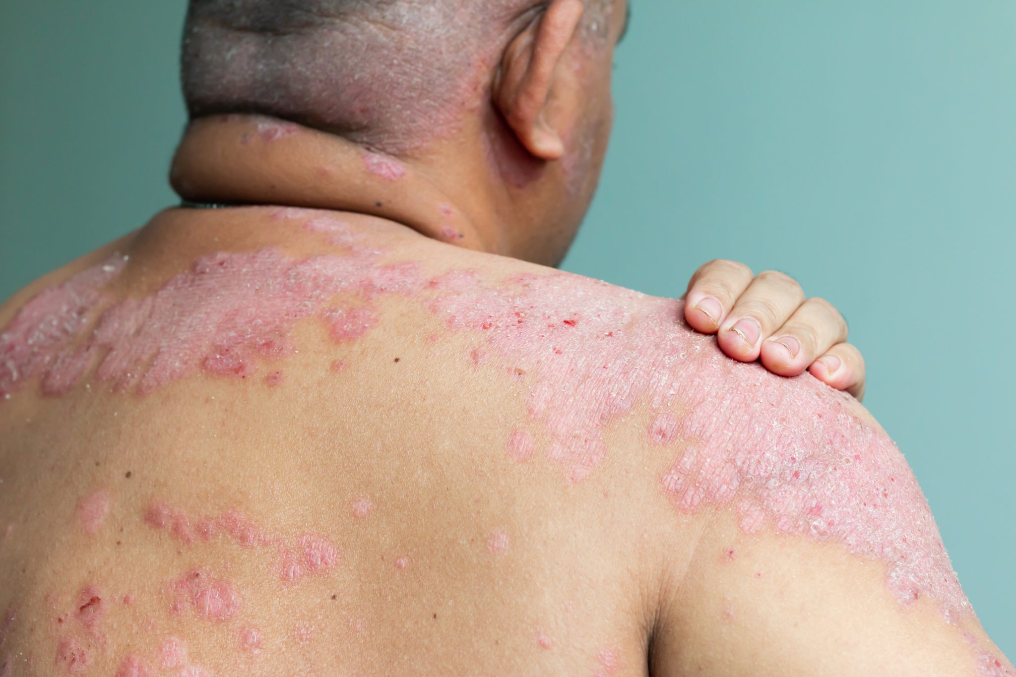 "Understanding Psoriasis and its Link to Vitamin D" Fit Life Insights