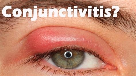 Conjunctivitis care tips
