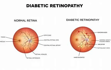 Diabetes retinopathy, vision loss