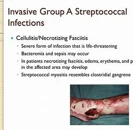 Invasive Strep A