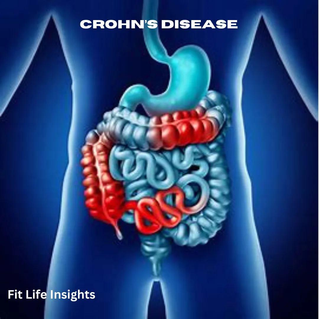 Crohn's Disease facts